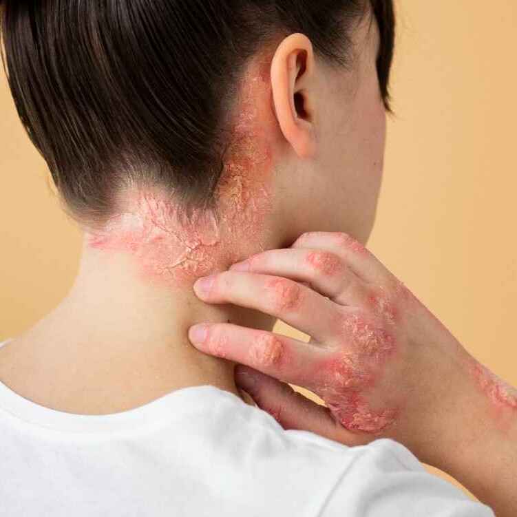 Psoriasis